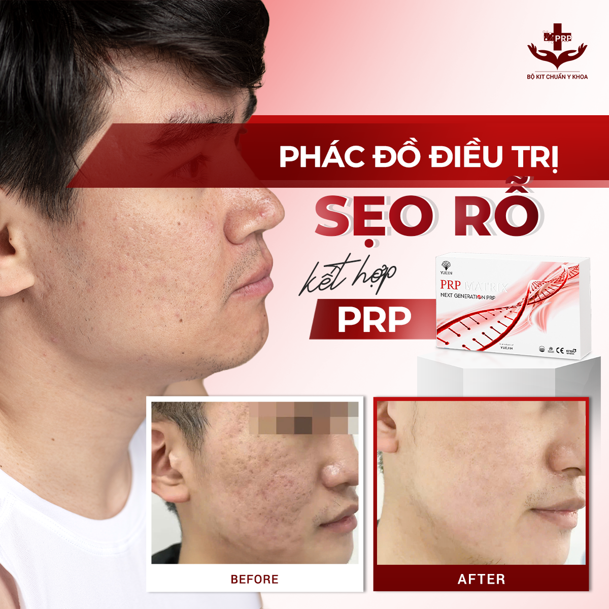 BỘ KIT PRP MATRIX YUEJIN 