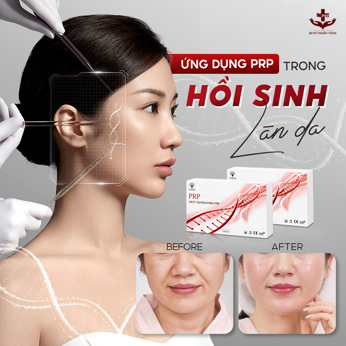 BỘ KIT PRP MATRIX YUEJIN 