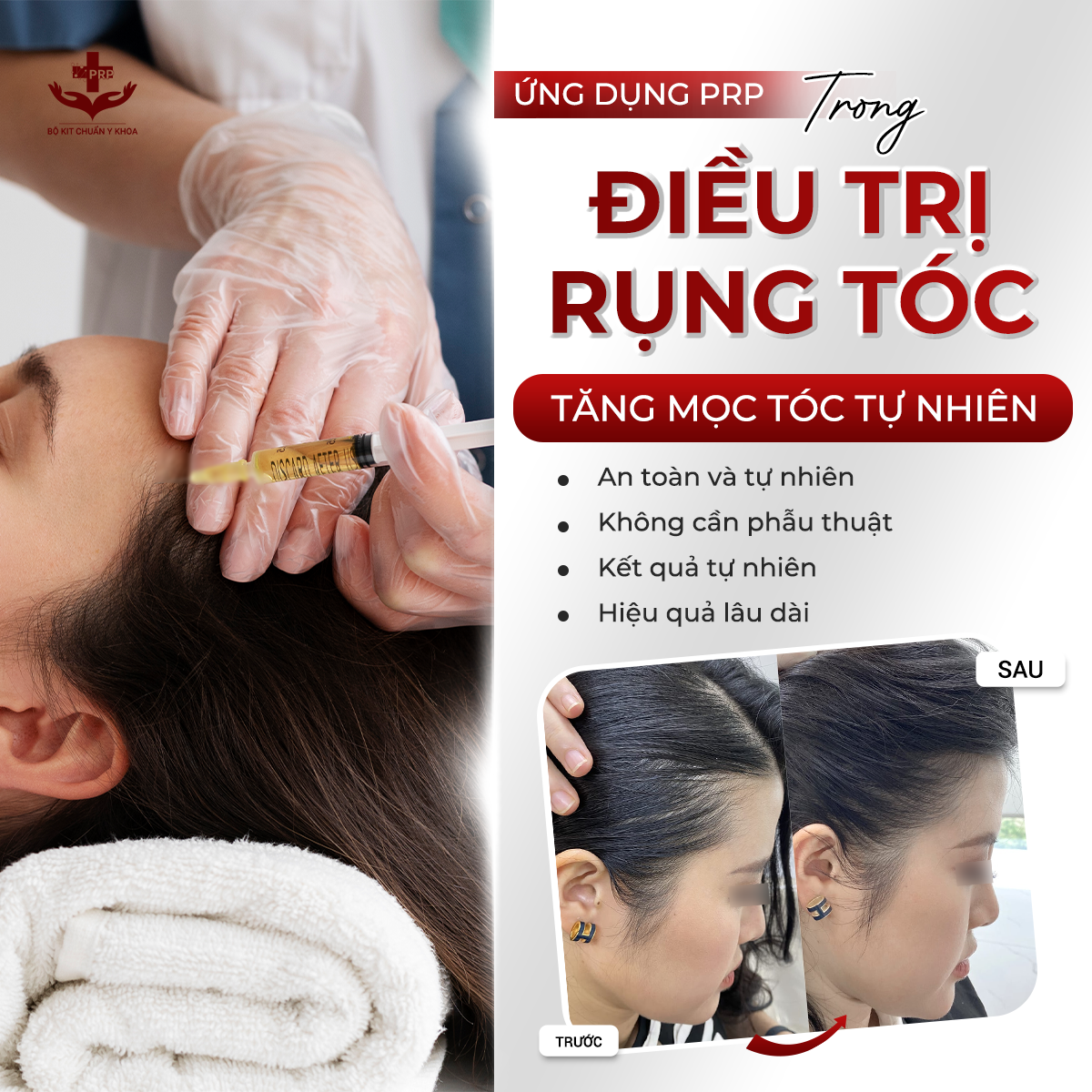 BỘ KIT PRP MATRIX YUEJIN 