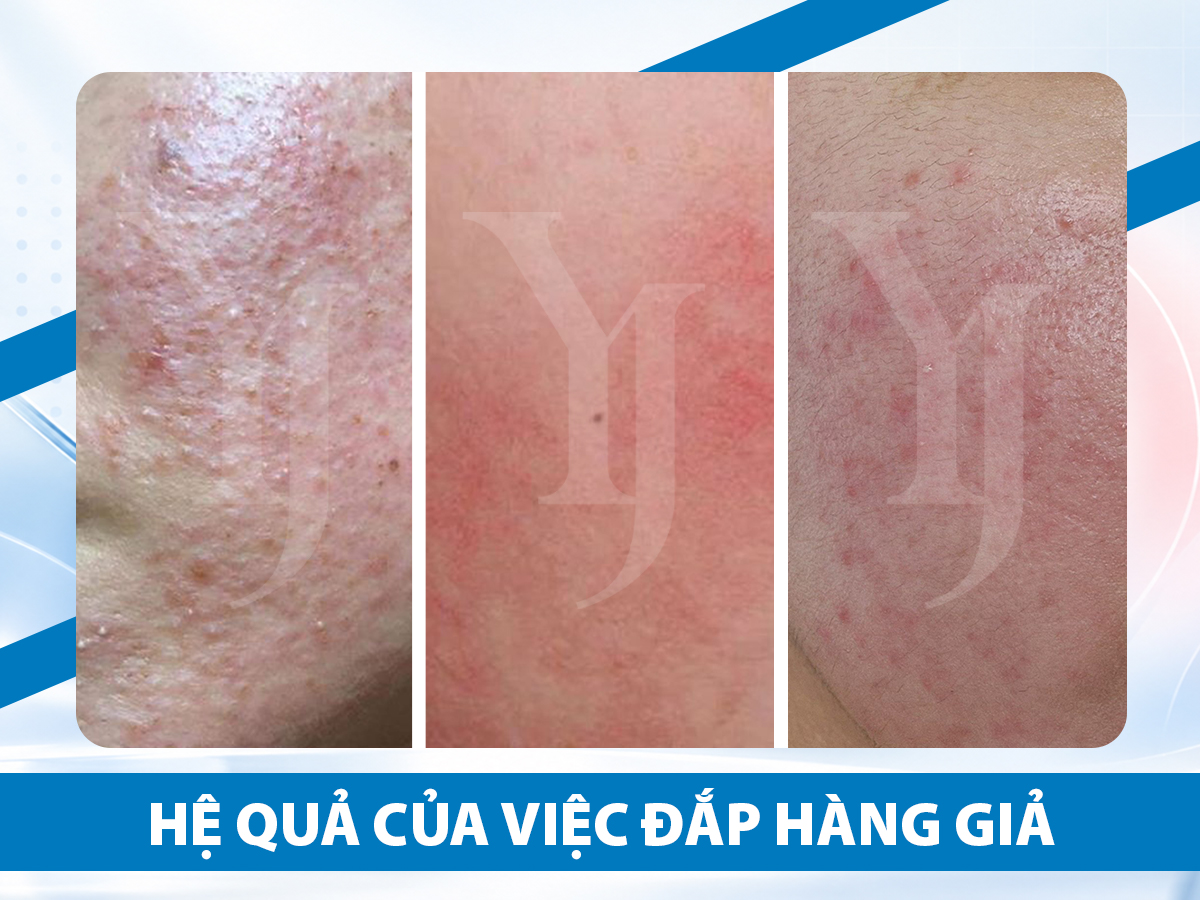 He qua cua viec dap mat na B5 gia